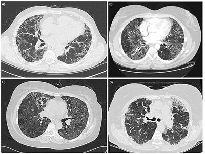 Case Report: Paclitaxel-Induced Pneumonitis in Early Breast Cancer: A Single Institution Experience and Review